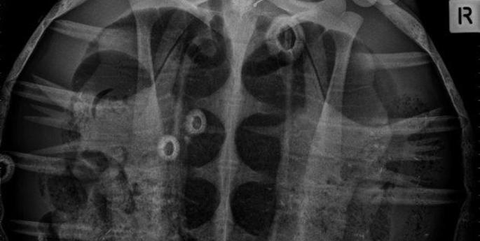 Marine debris puts three endangered turtles in Intensive Care at Taronga